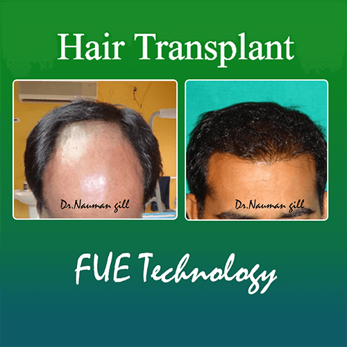 hairtransplant11266666666