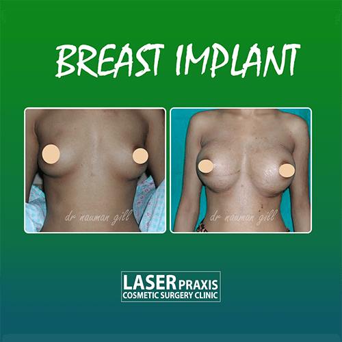 breastimplant455555