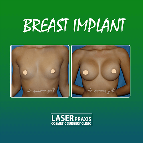 breastimplant45555555