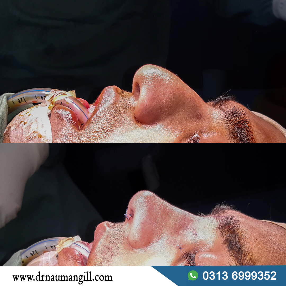 Nose Reshaping Rhinoplasty | Dr. Nauman Gill